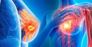 اپي سيالين CA15-3 ساختمان و اهميت آن بر پيشرفت سرطان سينه