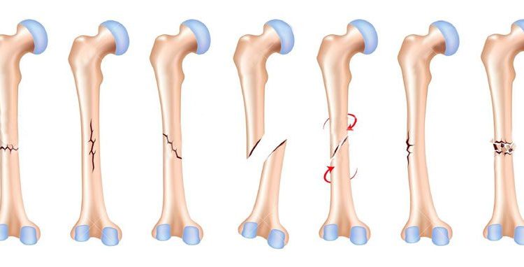 عوارض شکستگی ها
